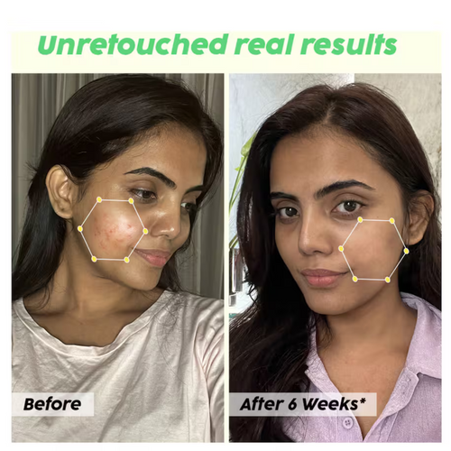 Skin Reborn - #1 Acne Controlling Serum + Free Lip Scrub - alternate view